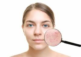 Revamin Acne Cream - bivirkninger